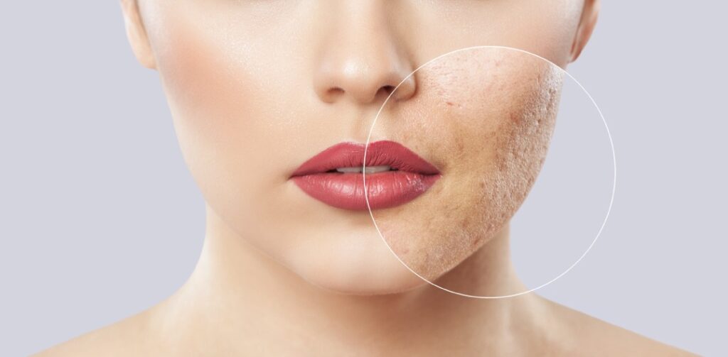 آر اف فرکشنال برای جای جوش